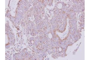 IHC-P Image Immunohistochemical analysis of paraffin-embedded human colon carcinoma, using NDUFS1, antibody at 1:250 dilution.