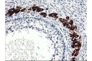 Immunohistochemical staining of paraffin-embedded Adenocarcinoma of Human ovary tissue using anti-PTPN7 mouse monoclonal antibody. (PTPN7 anticorps)