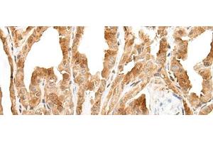 Immunohistochemistry of paraffin-embedded Human thyroid cancer tissue using ZPBP Polyclonal Antibody at dilution of 1:30(x200) (ZPBP anticorps)