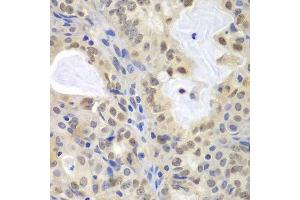 Immunohistochemistry of paraffin-embedded human oophoroma using MCM3 antibody.
