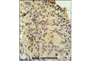 RSPO2 Antibody (C-term) (ABIN651457 and ABIN2840250) immunohistochemistry analysis in formalin fixed and paraffin embedded human lung carcinoma followed by peroxidase conjugation of the secondary antibody and DAB staining. (RSPO2 anticorps  (C-Term))