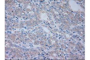 Immunohistochemical staining of paraffin-embedded Carcinoma of thyroid tissue using anti-NRBP1mouse monoclonal antibody. (NRBP1 anticorps)