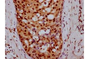 IHC image of ABIN7127442 diluted at 1:100 and staining in paraffin-embedded human breast cancer performed on a Leica BondTM system.