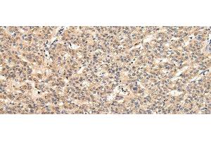 Immunohistochemistry of paraffin-embedded Human liver cancer tissue using VPS33B Polyclonal Antibody at dilution 1:40