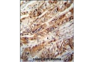 ZC3H15 antibody (C-term) (ABIN654819 and ABIN2844492) immunohistochemistry analysis in formalin fixed and paraffin embedded human colon carcinoma followed by peroxidase conjugation of the secondary antibody and DAB staining. (ZC3H15 anticorps  (C-Term))