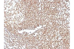 Formalin-fixed, paraffin-embedded human colon stained with P16INK4a Mouse Monoclonal Antibody (CDKN2A/3830). (CDKN2A anticorps)