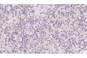 ABIN6273094 at 1/100 staining Human lymph cancer tissue by IHC-P. (BCO2 anticorps  (Internal Region))