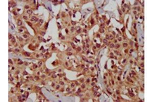 IHC image of ABIN7146680 diluted at 1:300 and staining in paraffin-embedded human liver cancer performed on a Leica BondTM system. (CHST11 anticorps  (AA 214-330))