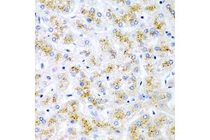 Immunohistochemistry of paraffin-embedded human liver injury using WNT2 antibody (ABIN5973475) at dilution of 1/200 (40x lens).