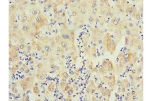 Immunohistochemistry of paraffin-embedded human liver cancer using ABIN7174120 at dilution of 1:100