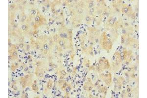 Immunohistochemistry of paraffin-embedded human liver cancer using ABIN7174120 at dilution of 1:100 (PTPN7 anticorps  (AA 1-190))