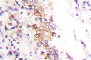 Immunohistochemical analysis of paraffin-embedded human lung cancer tissue using PIAS1 polyclonal antibody . (PIAS1 anticorps)