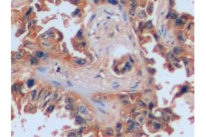 Detection of ICAM1 in Human Lung cancer Tissue using Polyclonal Antibody to Intercellular Adhesion Molecule 1 (ICAM1)