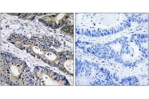 Immunohistochemistry analysis of paraffin-embedded human colon carcinoma, using GLB1L3 Antibody. (GLB1L3 anticorps  (AA 291-340))