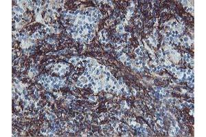 Immunohistochemical staining of paraffin-embedded Human lymphoma tissue using anti-VCAM1 mouse monoclonal antibody. (VCAM1 anticorps)