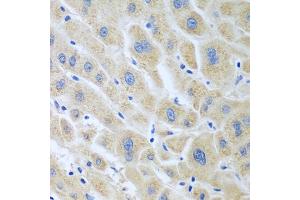 Immunohistochemistry of paraffin-embedded human liver cancer using BLVRB antibody. (BLVRB anticorps)
