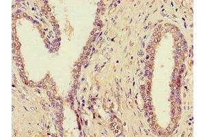 Immunohistochemistry of paraffin-embedded human prostate cancer using ABIN7164562 at dilution of 1:100 (ZDHHC1 anticorps  (AA 283-389))