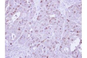 IHC-P Image Immunohistochemical analysis of paraffin-embedded NCIN87 Xenograft, using cyclin A , antibody at 1:500 dilution. (Cyclin A anticorps)