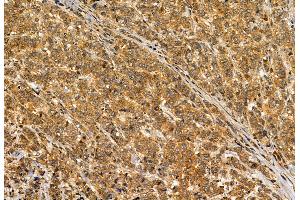ABIN6264901 and ABIN6272886 at 1/100 staining Human breast cancer by IHC-P. (S100A14 anticorps  (N-Term))