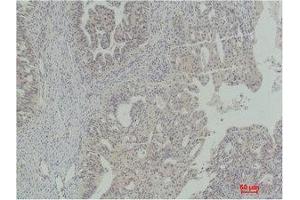 Immunohistochemistry (IHC) analysis of paraffin-embedded Human Ovarian Carcinoma using Stat5a Polyclonal Antibody. (STAT5A anticorps)