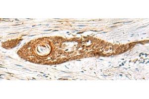 Immunohistochemistry of paraffin-embedded Human esophagus cancer tissue using GPSM1 Polyclonal Antibody at dilution of 1:85(x200)