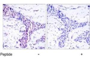 Immunohistochemical analysis of paraffin-embedded human breast carcinoma tissue using ATF2 polyclonal antibody  . (ATF2 anticorps)