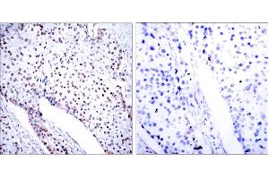 Immunohistochemistry analysis of paraffin-embedded human breast carcinoma tissue, using STAT3 (Ab-705) Antibody. (STAT3 anticorps)