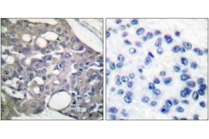Immunohistochemistry analysis of paraffin-embedded human breast carcinoma, using SHP-1 (Phospho-Tyr536) Antibody. (SHP1 anticorps  (pTyr536))