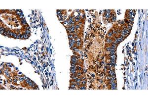Immunohistochemistry of paraffin-embedded Human colon cancer tissue using ITGA7 Polyclonal Antibody at dilution 1:35 (ITGA7 anticorps)