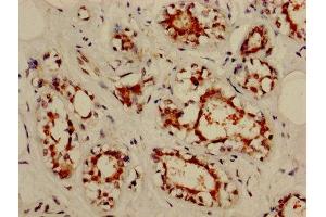 IHC image of ABIN7161970 diluted at 1:800 and staining in paraffin-embedded human breast cancer performed on a Leica BondTM system.