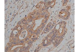 ABIN6269036 at 1/200 staining human colon cancer tissue sections by IHC-P.