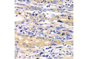 Immunohistochemistry of paraffin-embedded human gastric cancer using SARS antibody.