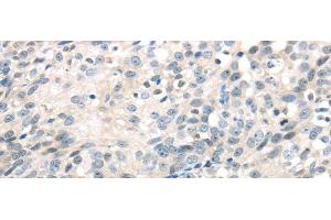 Immunohistochemistry of paraffin-embedded Human ovarian cancer using IQGAP2 Polyclonal Antibody at dilution of 1/40 (IQGAP2 anticorps)