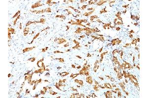 Formalin-fixed, paraffin-embedded human Breast Carcinoma stained with HSP27 Monoclonal Antibody (G3.