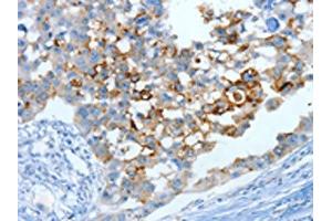 The image on the left is immunohistochemistry of paraffin-embedded Human breast cancer tissue using ABIN7130299(MUC15 Antibody) at dilution 1/25, on the right is treated with fusion protein. (MUC15 anticorps)