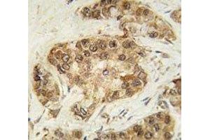 IHC analysis of FFPE human breast carcinoma tissue stained with CDK2 antibody