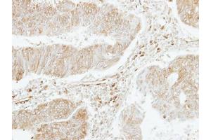 IHC-P Image Immunohistochemical analysis of paraffin-embedded human colon carcinoma, using PF4V1, antibody at 1:250 dilution. (PF4V1 anticorps  (C-Term))
