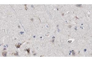 ABIN6272328 at 1/100 staining Human brain cancer tissue by IHC-P.
