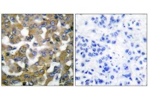 Immunohistochemical analysis of paraffin-embedded human breast carcinoma tissue using Keratin 19 antibody (ABIN5976439). (Cytokeratin 19 anticorps  (Internal Region))
