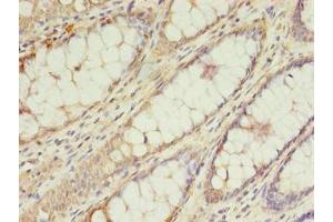 Immunohistochemistry of paraffin-embedded human colon cancer using ABIN7173516 at dilution of 1:100