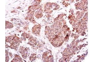 IHC-P Image EIF4E2 antibody [N1C3] detects EIF4E2 protein at cytoplasm on human breast carcinoma by immunohistochemical analysis. (EIF4E2 anticorps)