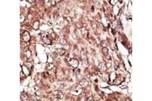 IHC analysis of FFPE human hepatocarcinoma stained with the PRMT7 antibody (PRMT7 anticorps  (AA 1-30))