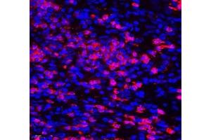 Immunofluorescence of paraffin embedded human colon cancer using Aldh4a1 (ABIN7073000) at dilution of 1: 400 (400x lens)