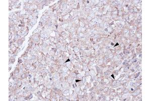 IHC-P Image Immunohistochemical analysis of paraffin-embedded CL1-0 xenograft, using SCARA3, antibody at 1:100 dilution. (SCARA3 anticorps)