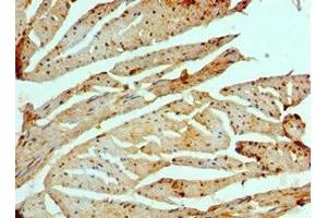 Immunohistochemistry of paraffin-embedded human prostate cancer using ABIN7151465 at dilution of 1:100 (GCN2 anticorps  (AA 1-300))