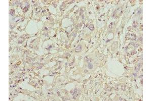 Immunohistochemistry of paraffin-embedded human pancreatic cancer using ABIN7163613 at dilution of 1:100 (PLA2G7 anticorps  (AA 49-441))