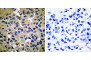 Peptide - +Immunohistochemical analysis of paraffin-embedded human breast carcinoma tissue using Collagen II antibody (#C0155). (COL2 anticorps)