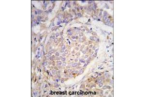 Formalin-fixed and paraffin-embedded human breast carcinoma tissue reacted with MAGEA10 antibody , which was peroxidase-conjugated to the secondary antibody, followed by DAB staining. (MAGEA10 anticorps  (C-Term))
