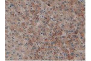 IHC-P analysis of Human Liver Cancer Tissue, with DAB staining. (PLAT anticorps  (AA 36-126))