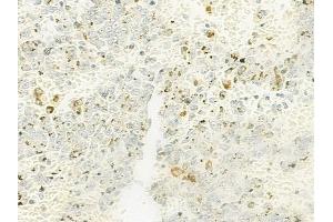 ABIN6263234 and ABIN6272659 at 1/100 staining human melanoma by IHC-P. (MFGE8 anticorps  (C-Term))